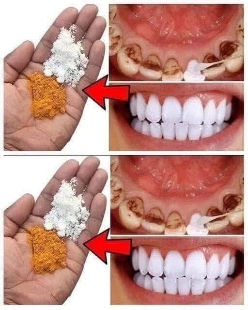 Teeth whitening in just 2 minutes – turning yellow and accumulated tartar into milk